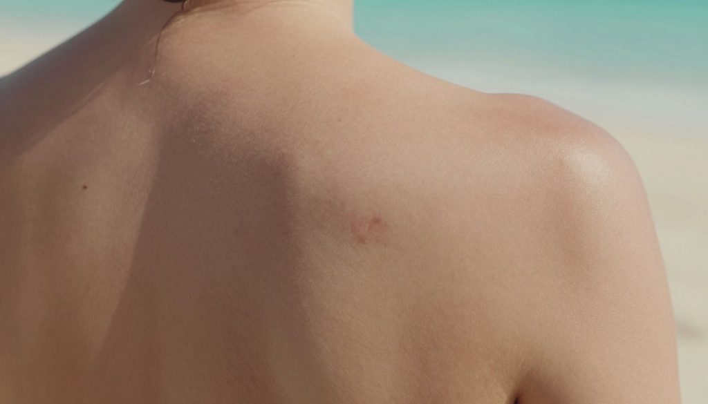 A close-up image showcasing a person's back revealing skin with noticeable blemishes and dark spots, symbolizing skin issues like acne scars and discoloration. The foreground focuses on the textured skin, illuminated by soft, natural light to highlight the nuances of the imperfections. In the middle ground, include subtle hints of summer elements, like a blurred beach background with soft pastel colors, suggesting a warm day. The overall atmosphere should convey a sense of caution, emphasizing the need for skincare and protection during the summer months. Capture the image from a slightly elevated angle to create depth, ensuring the skin remains the focal point without any distractions.